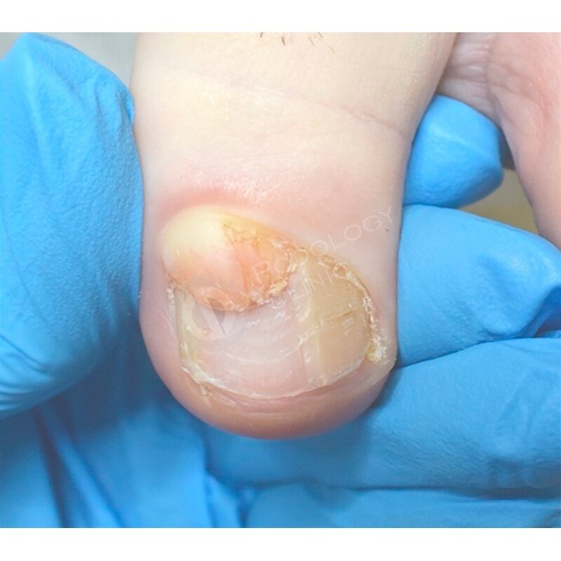 Фото случая из практики Клиники Подологии