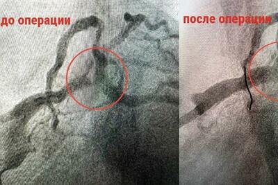    Снимок до и после операции в Подмосковье © Пресс-служба Министерства здравоохранения Московской области