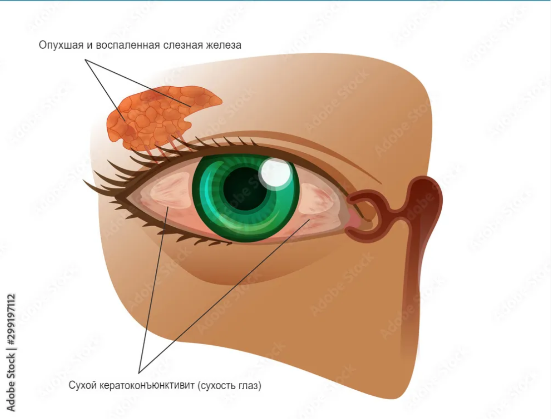 Синдром Шегрена - когда заподозрить и как обследоваться? | Григорий ...