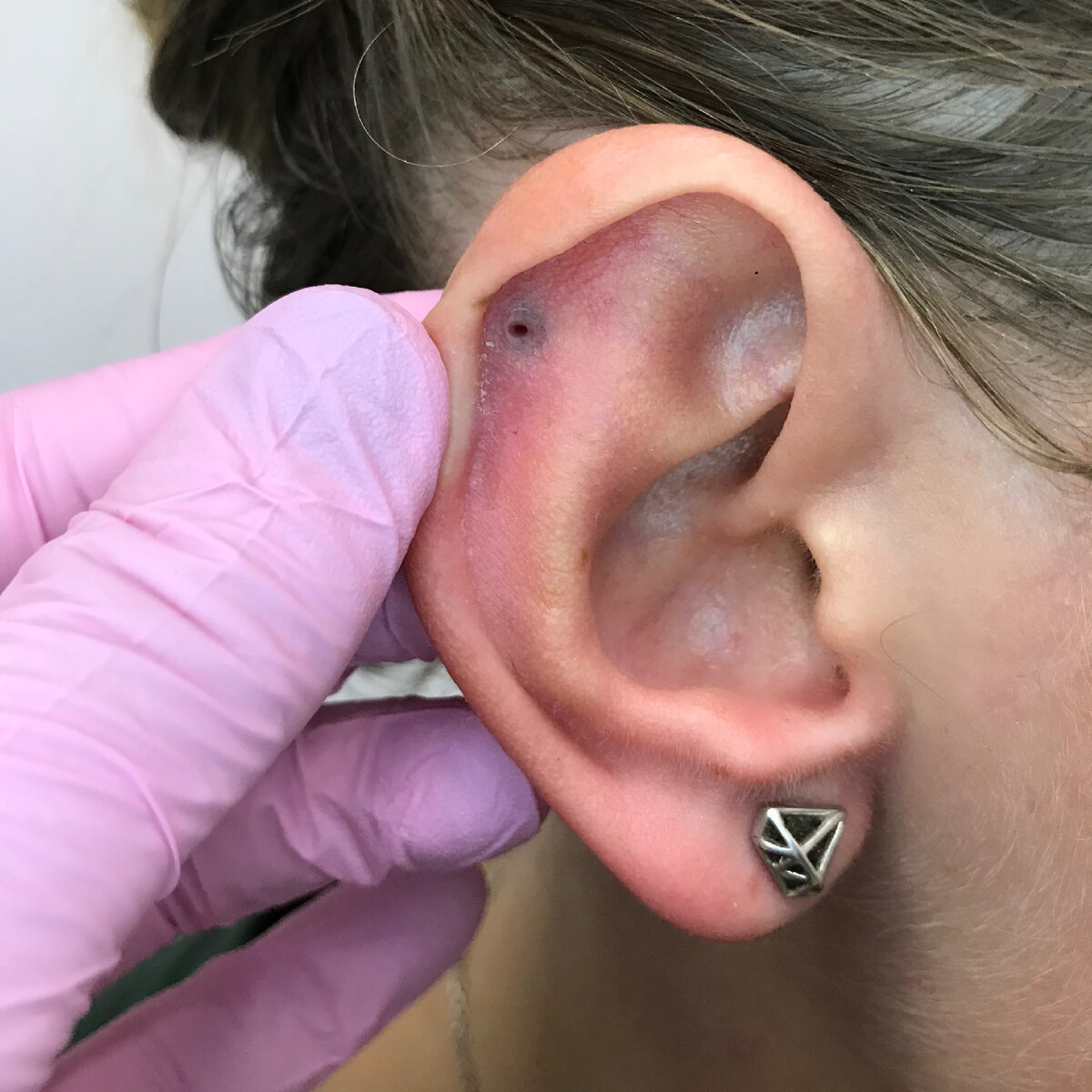 Контактная аллергия и последствия окисления украшения