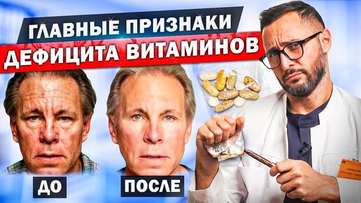 Внешние проявления недостатка витаминов. Витамины A, C, B, D, E, K