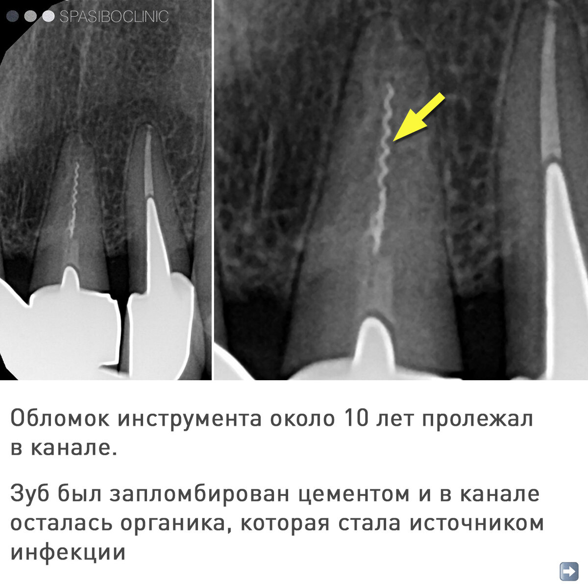 ОБЛОМОК ИНСТРУМЕНТА В КАНАЛЕ | Спасибо.Клиник | Дзен