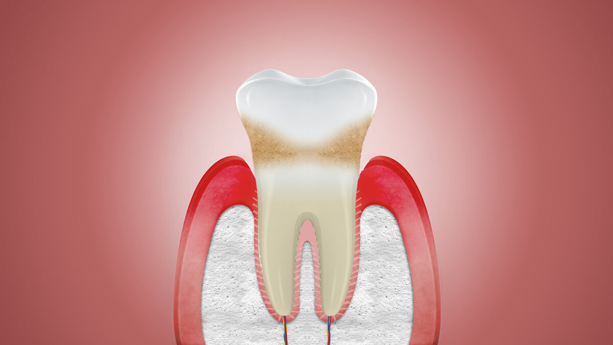 Как поступить, когда десна отходит от зуба: экспертные рекомендации и советы