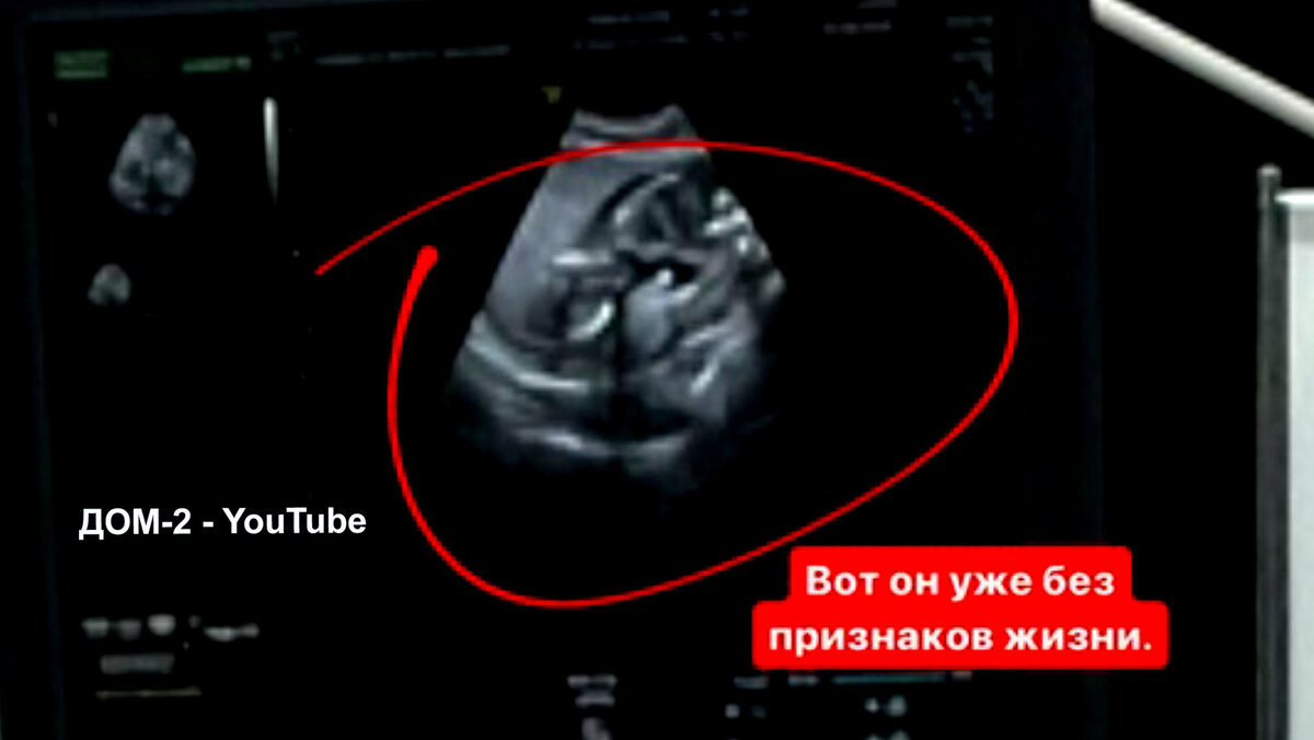 Ребята пришли на УЗИ втроём, инстаграм