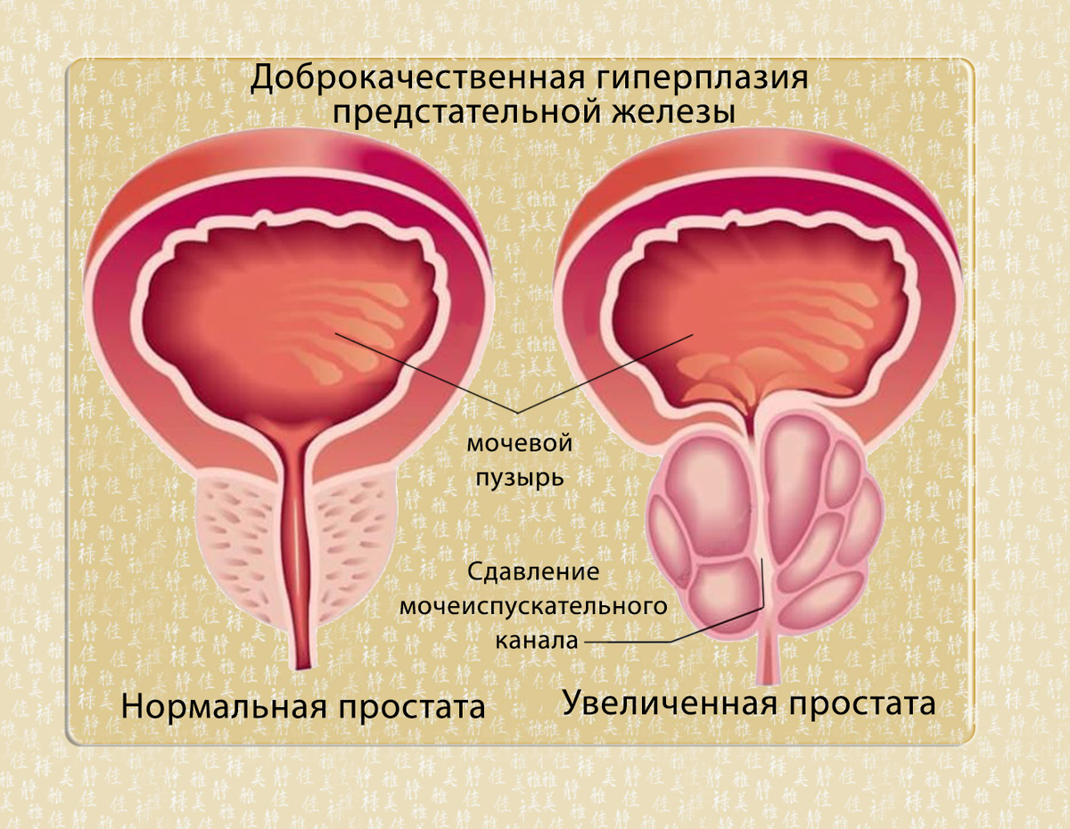 Dobrokachestvenaia giperplazia prostatelnoi yelezi