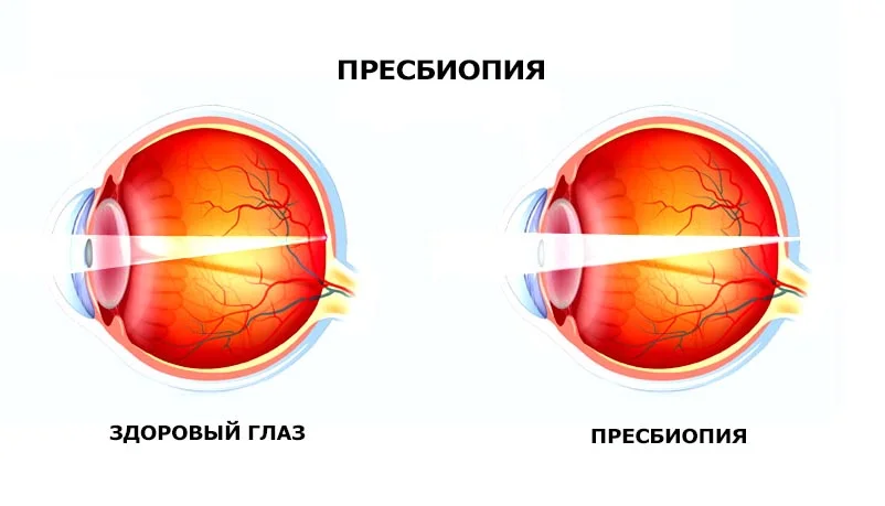 Федоров зрение коррекция