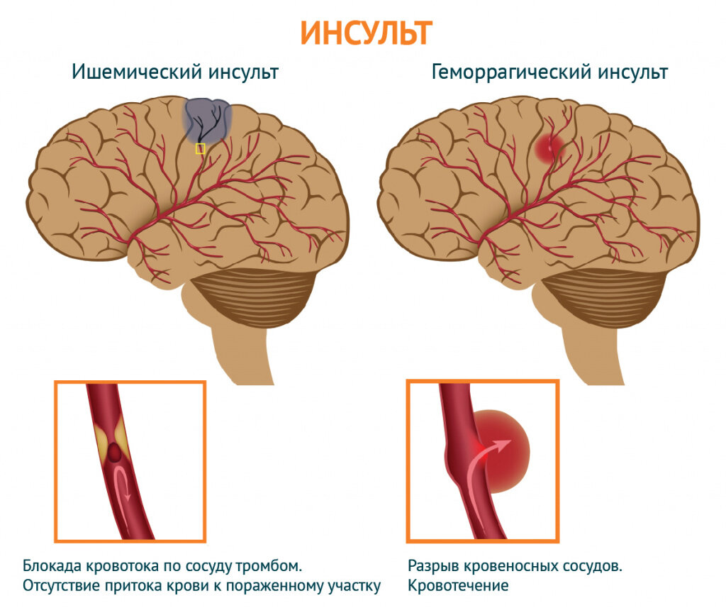 Виды инсульта. Повторный инсульт. Предвестники инсульта.