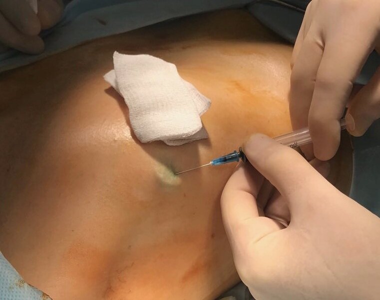 1.	Введение индоцианина зелёного над опухолью правой молочной железы. 0 мин.