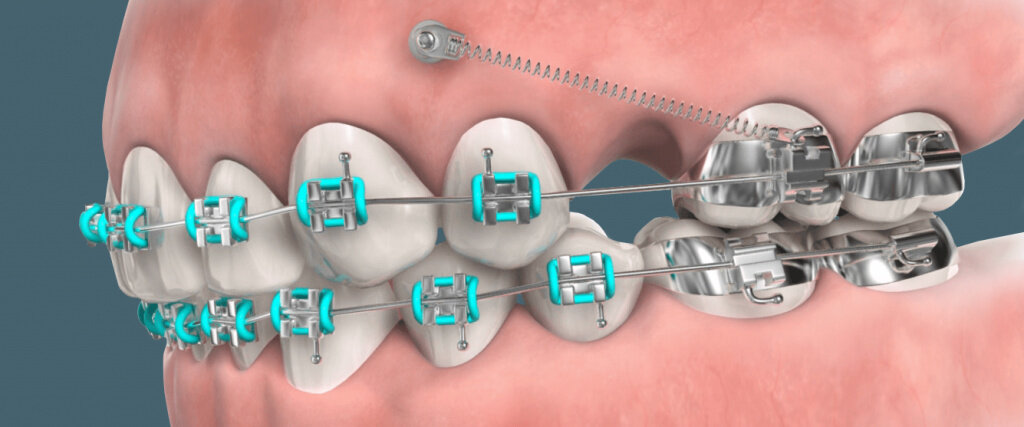 Ортодонтические мини-винты представляют собой одно из значимых изобретений, появившихся примерно 25 лет назад.
