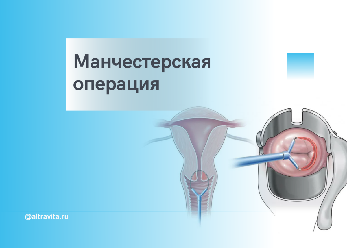 Манчестерская операция