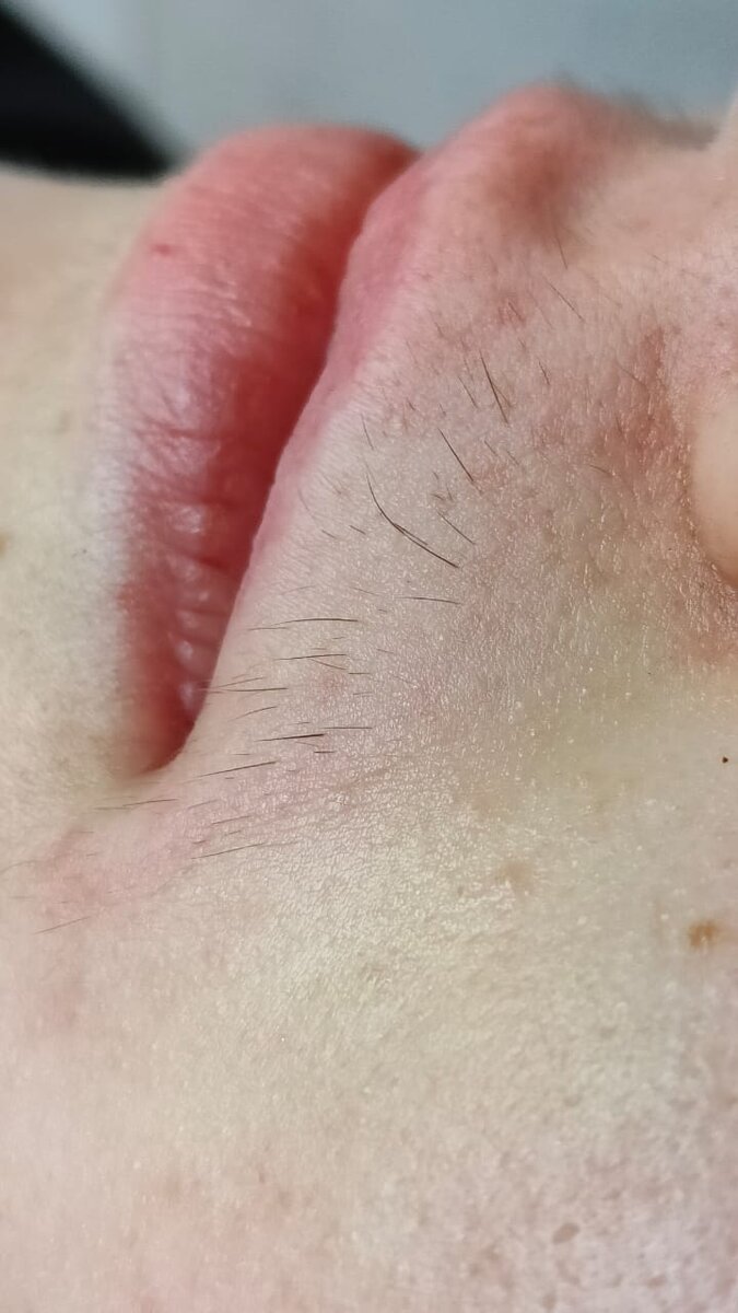 Вторичная процедура. Молодая девушка до 30 лет.