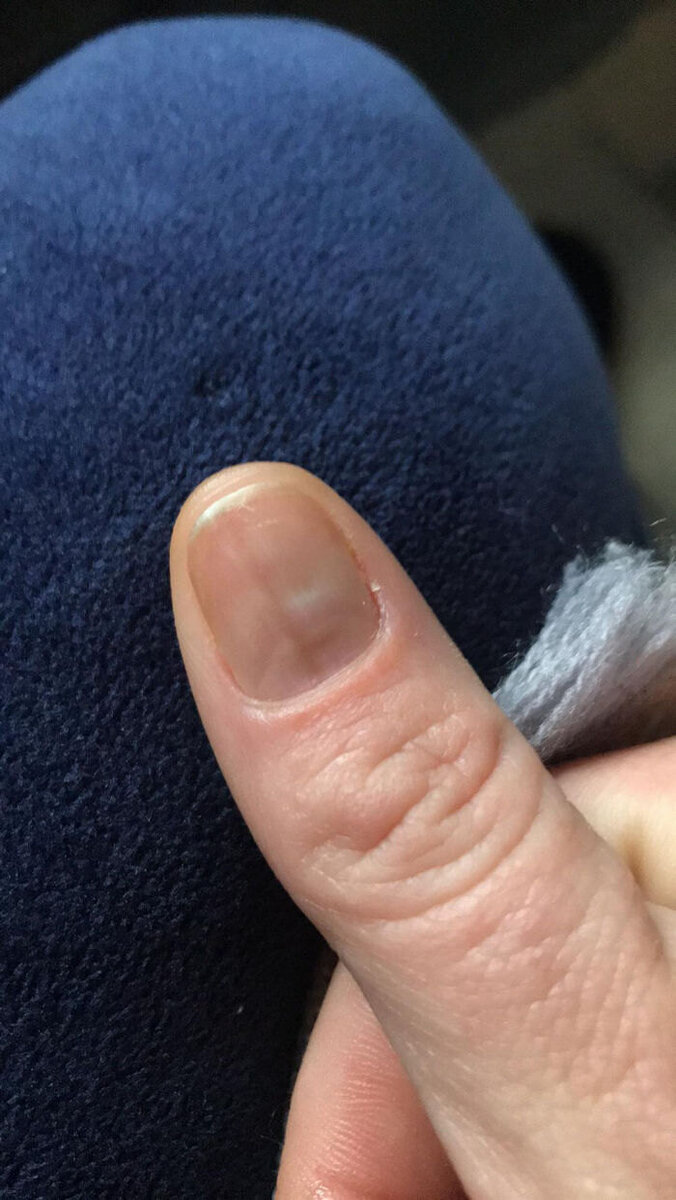    А так — после снятия наращивания.Фото: соцсети