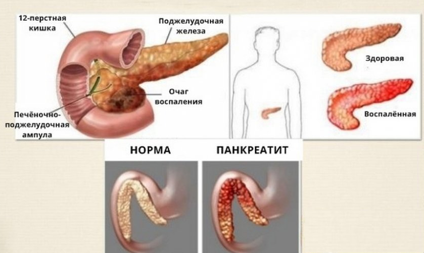 Диагноз «Панкреатит»