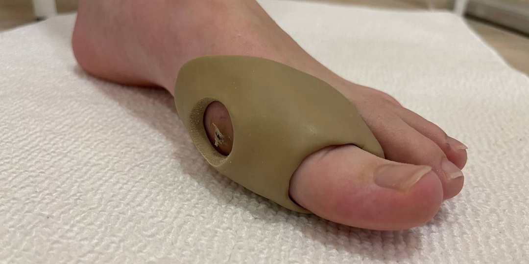 Не прошла мозоль даже после хирургического вмешательства