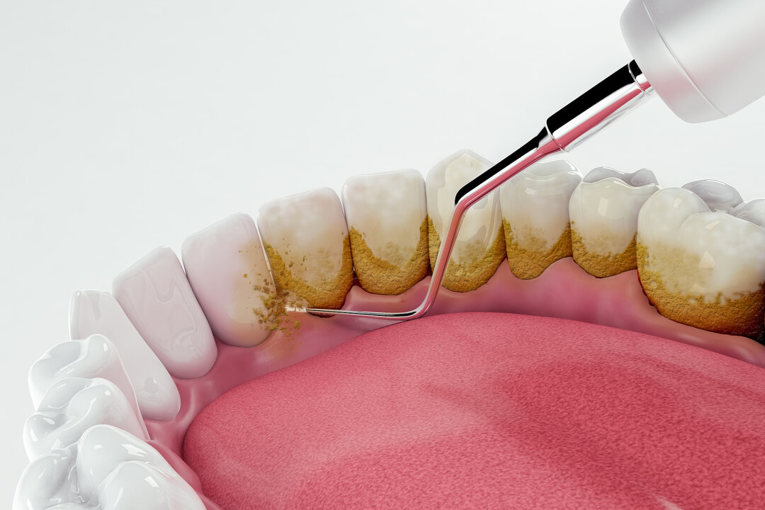 Причины, классификация и стадии развития пигментации зубов