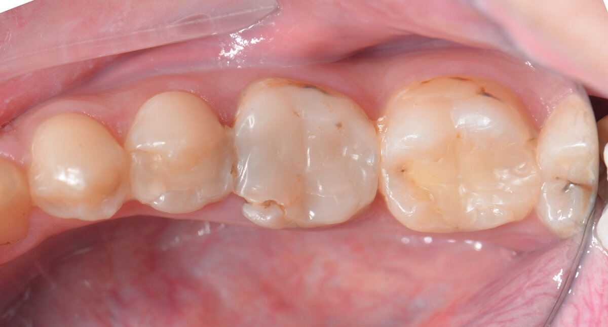 Старая пломба отличается по цвету, но это не единственный признак того, что ее пора менять. 
Фото: drhakancolak // Shutterstock 