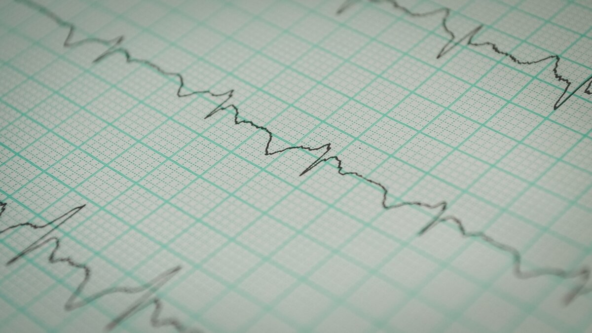     Мужчина едва не умер от инфаркта. О подвиге врачей рассказал в соцсетях глава Минздрава РК Михаил Охлопков.