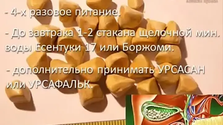 Камни в желчном пузыре питание. Питание при камнях в желчном. Камни в жёлчном пузыре диета. Питание при камнях в желчном пузыре. Диета при камнях в желчном пузыре.