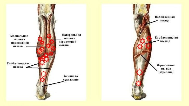 Судороги в ногах: причины, что делать, лечение