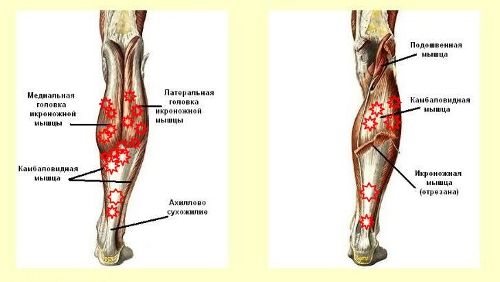 Мышцы голени задняя группа. Боль в икроножной мышце причины. Судорога икроножной мышцы.