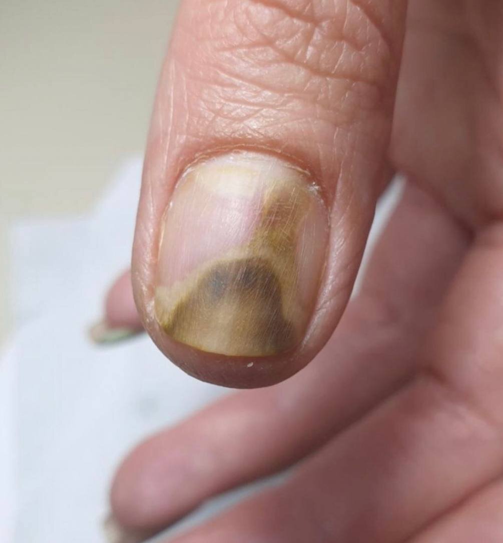 Так может выглядеть грибок