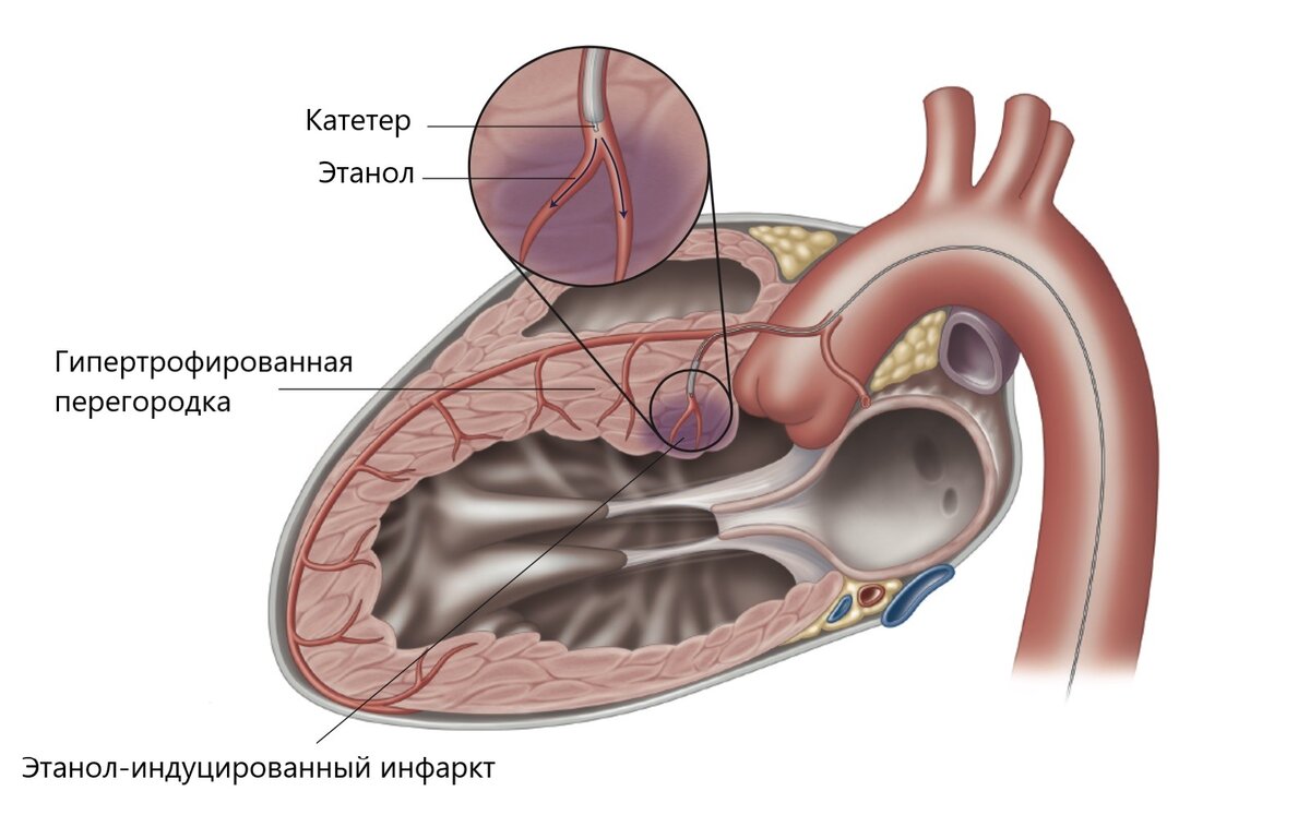 Заболевания сердца людей и кошек. Гипертрофическая кардиомиопатия |  SMARTCARDIO | Дзен