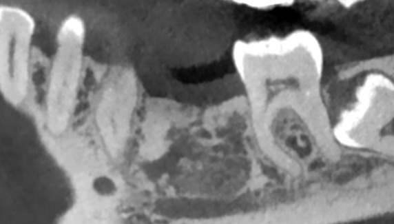 Состояние через 1 год. Кость приобрела свою характерную структуру, окрепла. Можно переходить к имплантации.