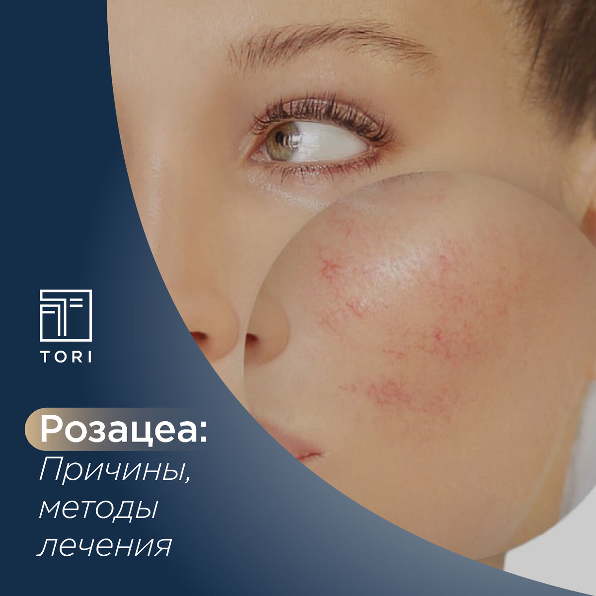 РОЗАЦЕА: ПРИЧИНЫ, МЕТОДЫ ЛЕЧЕНИЯ | Tori Clinic | Дзен