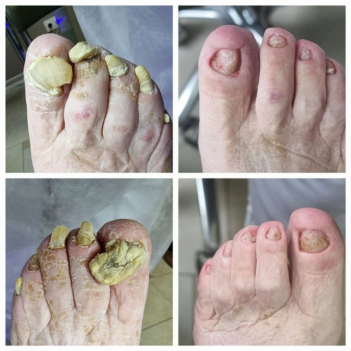 Запущенные случаи онихогрифоза тоже лечатся, но все-таки лучше не затягивать 