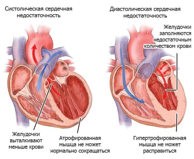 Сердечная недостаточность кардиального. Систолическая недостаточность левого желудочка. Систолическая и диастолическая сердечная недостаточность. Патогенез диастолической формы сердечной недостаточности. Хроническая сердечная недостаточность патогенез диастолической.