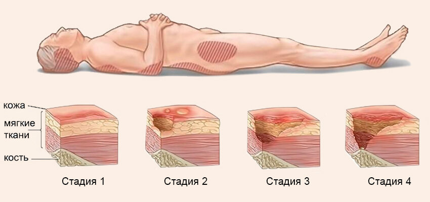 Пролежни: диагностика, лечение, профилактика