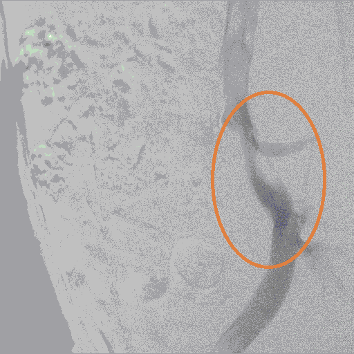 до стентирования