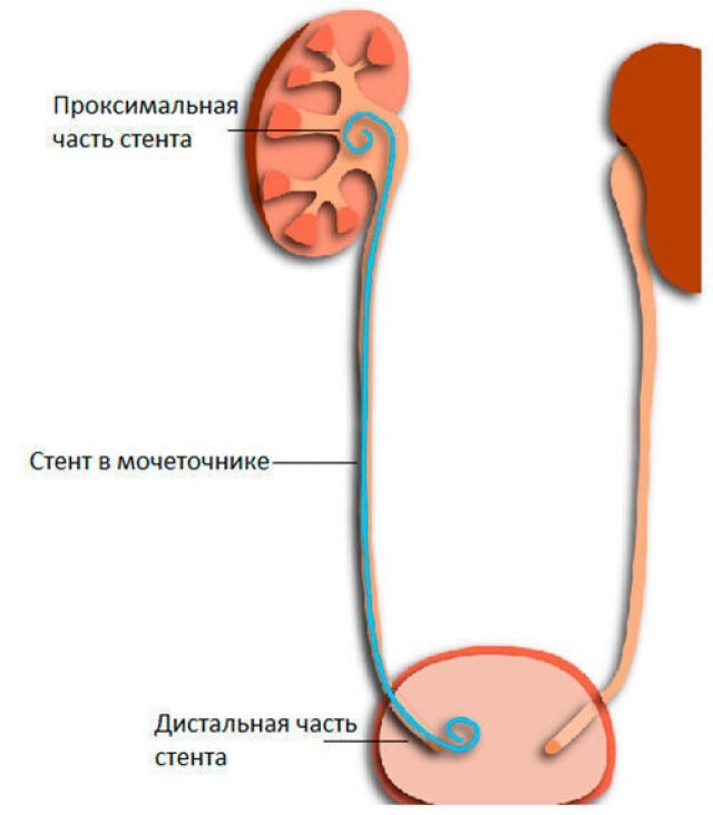 Сколько можно ходить со стентом в мочеточнике