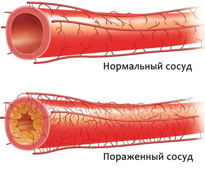 Здоровый сосуд и сосуд, пораженный атеросклерозом. Фото из открытых источников.