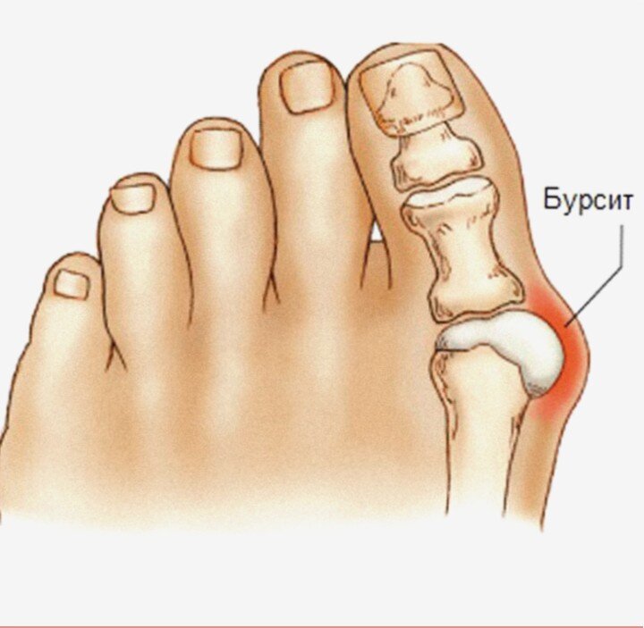 Бурсит на большом пальце ноги фото