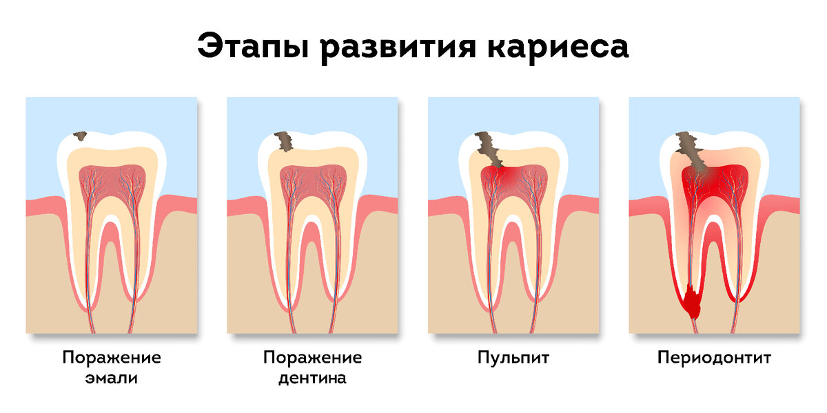Удача передаются через поцелуй. Может ли кариес передаваться через поцелуй. Передается ли кариес при поцелуе. Передаётся ли кариес при поцелуе. Передается ли кариес через поцелуй.