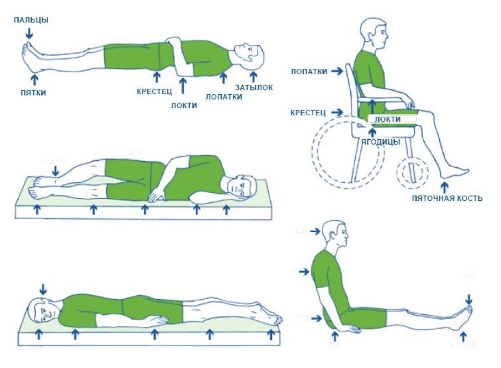 Пролежни сидя. Наиболее частые места локализации пролежней. Зоны риска образования пролежней. Места наиболее частого образования пролежней. Профилактика пролежней у лежачих больных.