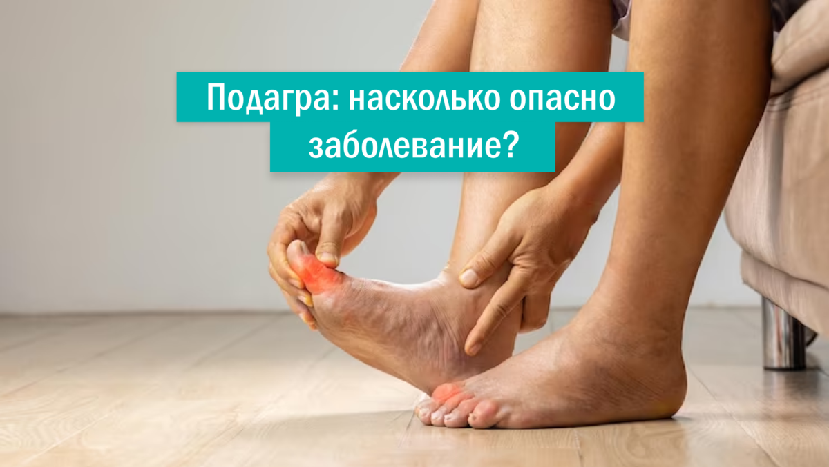 Подагра быстро снять боль. Боль в колене, суставах, при подагре быстро пройдет! Компресс и растирка Подагра: как быстро снять приступ и как вылечить? Как быстро облегчить боль при подагре на ногах в домашних