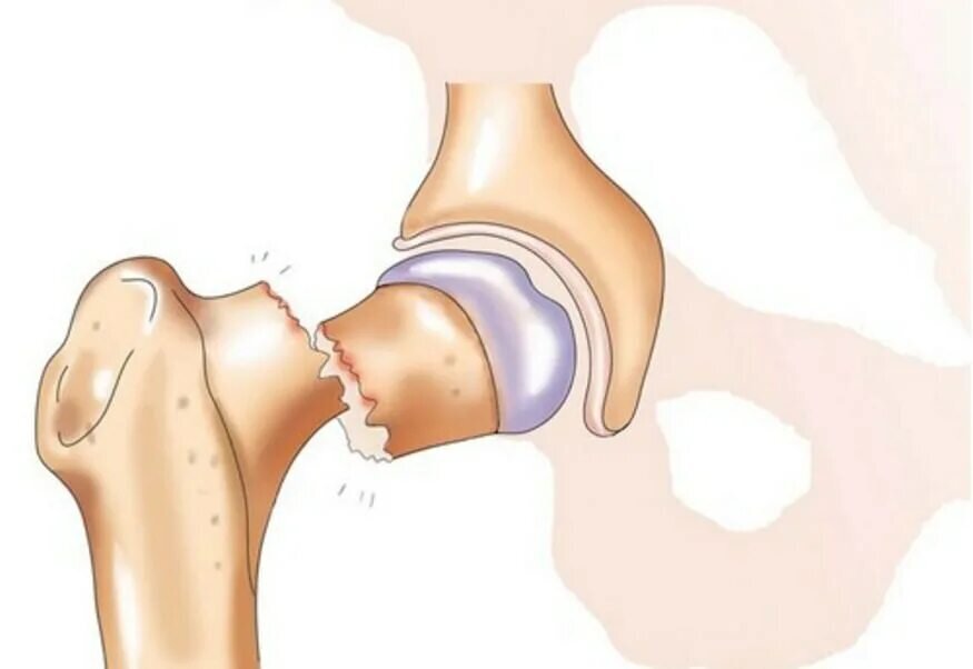 Шейка бедра перелом вколоченный. Остеопороз перелом шейки бедра. Тазобедренный сустав перелом шейки бедра. Базисцервикальный перелом шейки бедра.