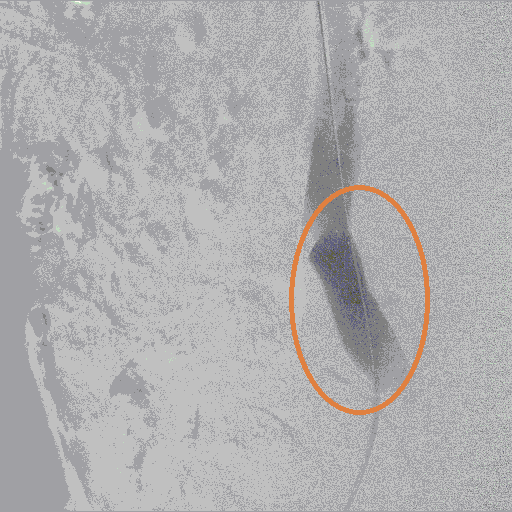 после стентирования