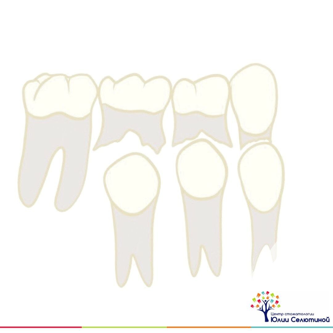 От зуба осталась только коронковая часть, корень полностью рассосался. При смене зубов это абсолютная норма. Называется этот процесс физиологическая резорбция.