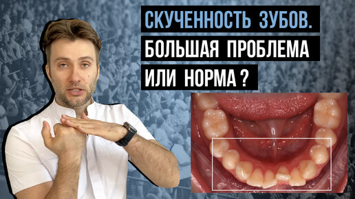 Скученность зубов - проблема или норма❓Нужно ли лечение❓