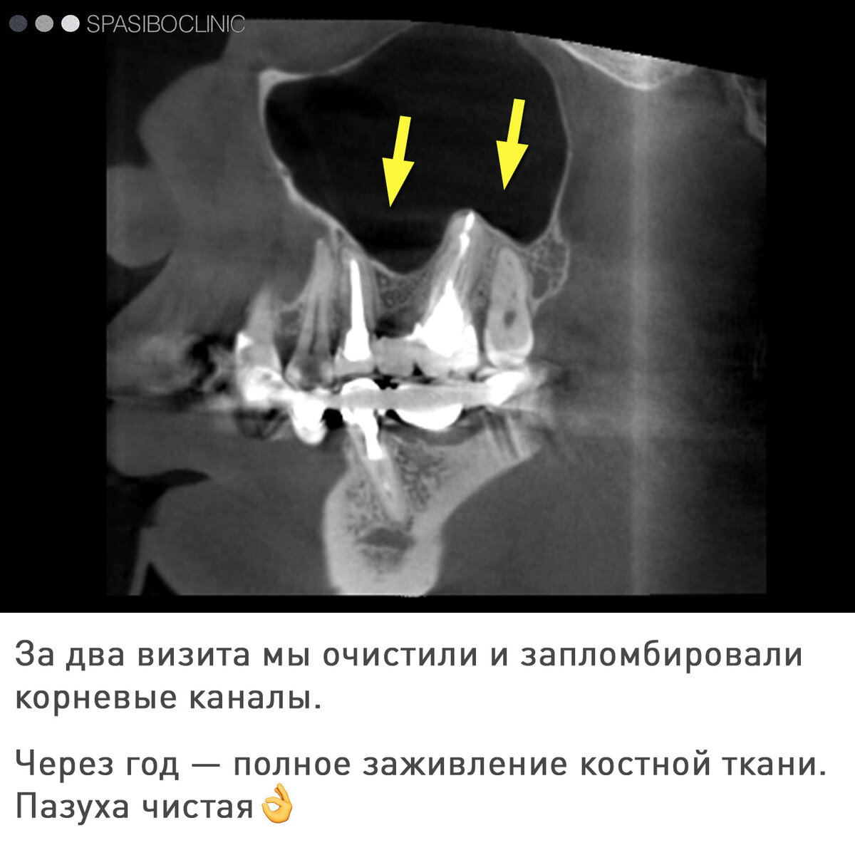 КИСТЫ: УДАЛЯТЬ? ЛЕЧИТЬ! | Спасибо.Клиник | Дзен
