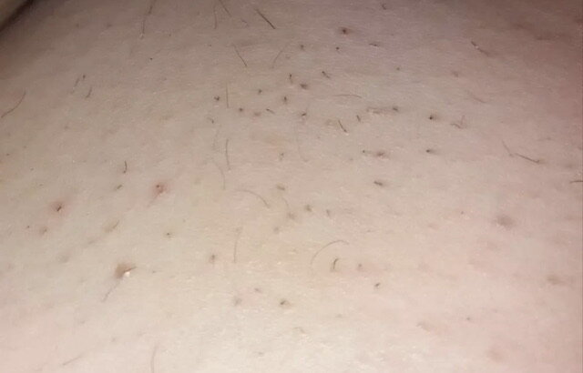 Почему появляются вросшие волосы. 