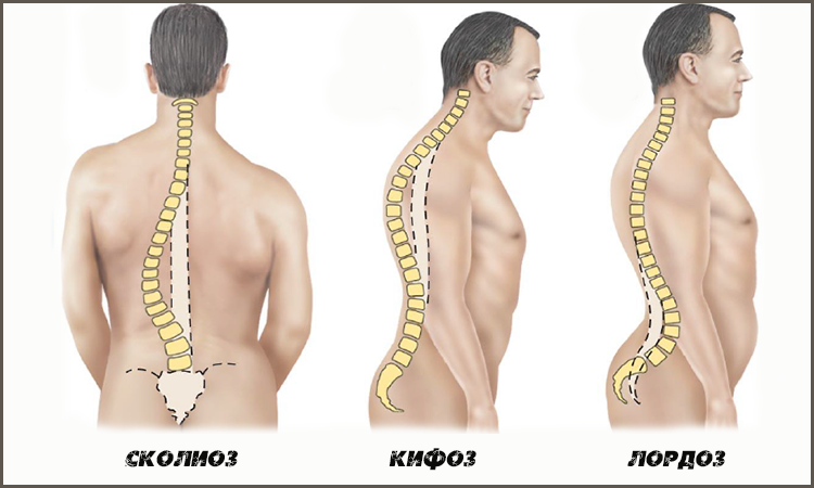 Лордоз кифоз сколиоз картинки