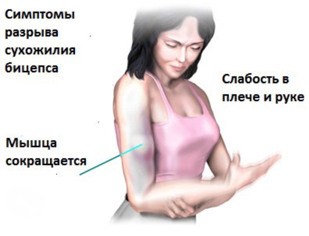 Травма мышцы симптомы. Тендинит двуглавой мышцы плеча симптомы. Симптомы разрыва сухожилия бицепса. Повреждение сухожилия двуглавой мышцы плеча. Растяжение головок двуглавой мышцы плеча.