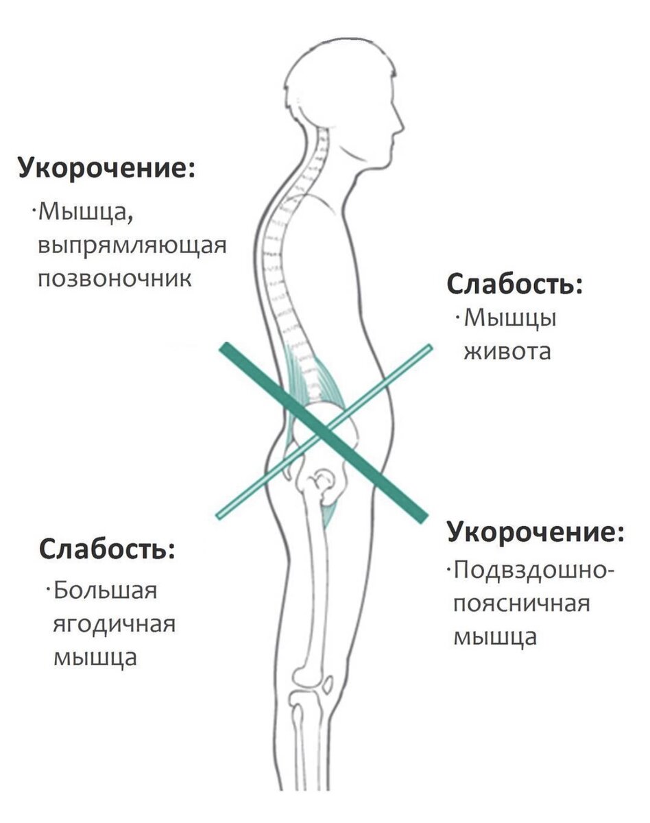 ЧТО БЫВАЕТ ПРИ НАРУШЕНИИ ОСАНКИ | ЙОГА ОНЛАЙН | Дзен