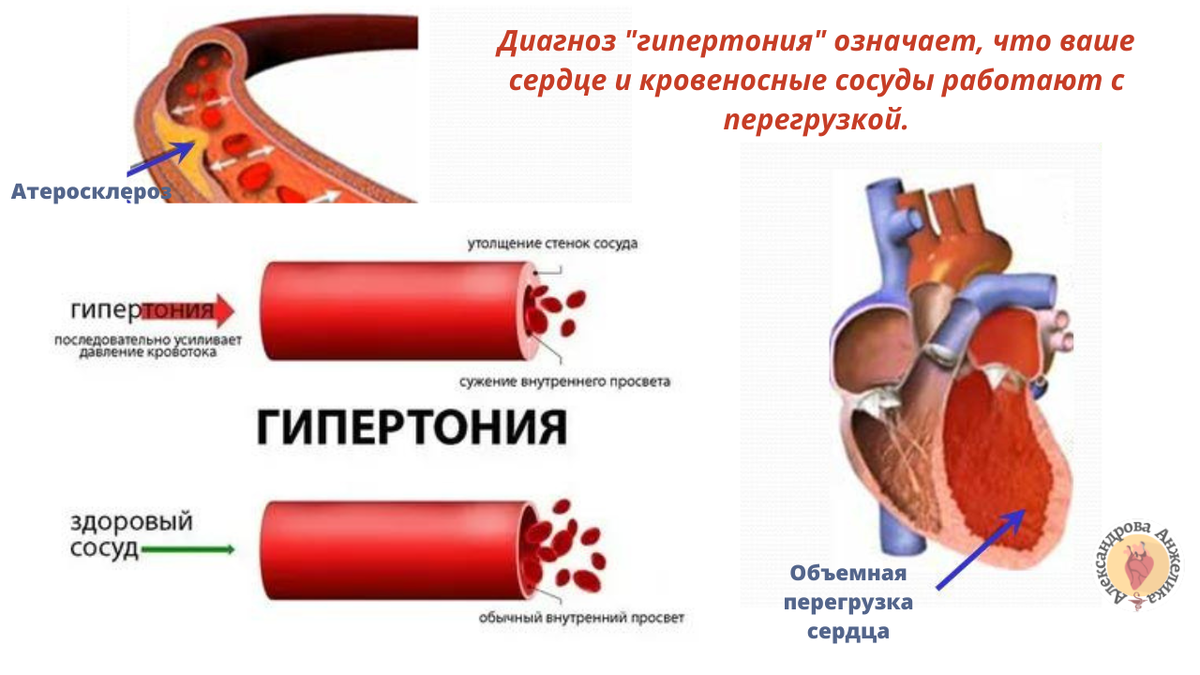 Гипертоническая болезнь 2 степени берут. Факторы риска развития артериальной гипертензии. Сердце при артериальной гипертензии. Факторы риска гипертонической болезни. Факторы риска развития артериальных тромбозов.