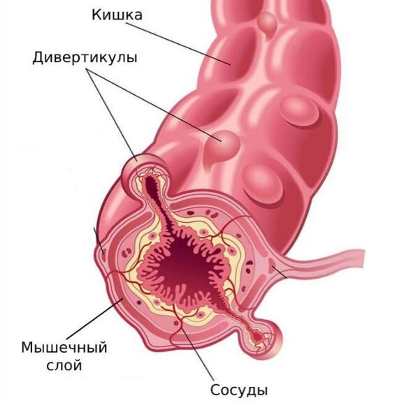 Атония кишечника