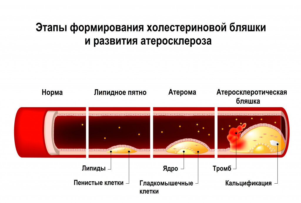 Симптомы атеросклероза сосудов шеи сонных артерий